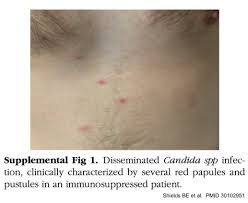Image result for Candidiasis