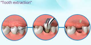 Where Do Your Teeth Actually Go After Extraction Well It S Different In Different Places Of Tooth Extraction Aftercare Tooth Extraction Tooth Decay Remedies