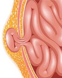 Know The Type Of Hernia You Have Before Hernia Surgery In Kolkata In 2020 Surgery Hernia Repair Epigastric Hernia
