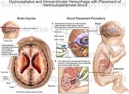 Intraventricular Hemorrhage Hydrocephalus And Intraventricular Hemorrhage With Placement Of Neonatal Nurse Pediatric Nursing Nicu Nurse
