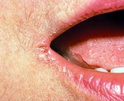 Image result for Angular Stomatitis