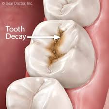 Check spelling or type a new query. 3 Ways To Reduce The Bacteria In Your Mouth That Cause Tooth Decay Woodbury Dental Care