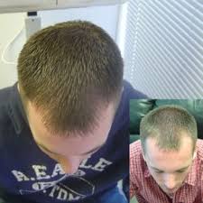 It delivers results that can influence your entire life. When Should Men Seek Laser Hair Treatment Hair Loss Restoration Replacement Connecticut