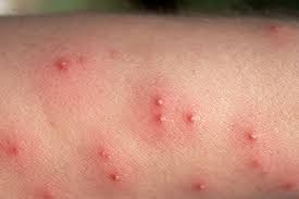 Image result for ant bite
