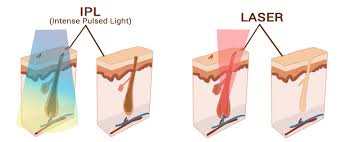 This quick, effective and safe treatment offers the vpl treatment uses short, safe controlled pulses of filtered light to remove unwanted hair in minutes. Super Hair Removal Shr Opt Laser Pigment Removal Skin Rejuvenation Suit All Skin Buy Shr Hair Removal Opt Ipl Hair Removal Product On Alibaba Com