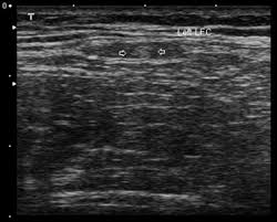Check spelling or type a new query. Ultrasound Guided Blockade Of The Lateral Femoral Cutaneous Nerve Technical Description And Review Of 10 Cases Sciencedirect