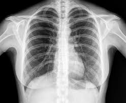 Image result for lung cancer xray