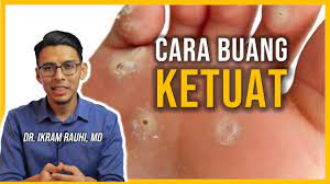 Ketuat menjadi sangat menyakitkan dan tidak boleh digerakkan. Ketuat Punca Jenis Dan Rawatan Cara Buang Ketuat Di Tapak Kaki Youtube