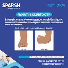 Image result for Clubfoot