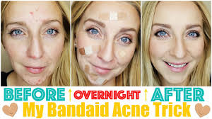 How To Get Rid Of Acne Fast Overnight With My Bandaid Trick Youtube