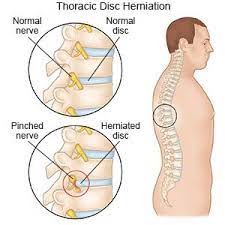 We did not find results for: Thoracic Disc Herniation What You Need To Know