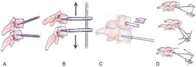 Stand up and put your hands on … Surgical Technique For Open Reduction Of Cervical Locked Facets A B Download Scientific Diagram