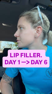 One year of consistency, care, and small changes can make such a  difference. ✨ These photos are taken a year apart. Over time, Christy has  added in gradual treatments—cheek and lip filler,