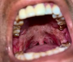 Image result for Erythroplakia roof of mouth