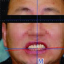 CVE prevention model based