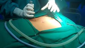 Returning up to the parking area. Palmers Point Entry In Laparoscopy Youtube