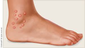 So, i am here to give readers a few ways to get rid of the maddening itch caused by chiggers. Chigger Bites For Parents Nemours