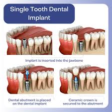 Image result for dental implant