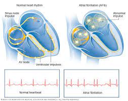 How long can a person live with atrial fibrillation. Atrial Fibrillation Symptoms And Causes Mayo Clinic