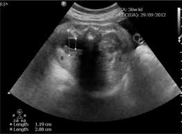 Revised Guidelines On Management Of Antenatal Hydronephrosis
