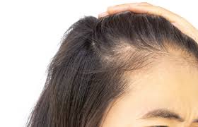 Copper deficiency & hair loss Does The Iud Cause Hair Loss Iud Alert