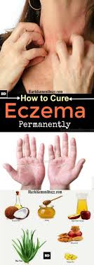 Comment Guerir L Eczema De Facon Permanente 10 Remedes Maison Pour L Eczema Home Remedies For Eczema Eczema Remedies Natural Eczema Remedies