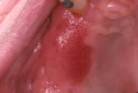 Image result for Erythroplakia roof of mouth