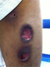 Maybe you would like to learn more about one of these? Rose Gardener S Disease Thorax