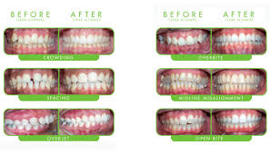 The main difference between most of these is the material that they are made of, or the specific purpose that. Clear Braces Clear Braces Cost Pawleys Island Dental Georgetown Dentists Rd