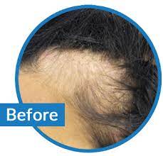 The first step in these patients is to discontinue the styling methods causing the injury. Hair Loss From Chemical Trauma