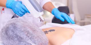 Laser tattoo removal techniques can significantly diminish the appearance of your unwanted tattoo with minimal side effects. Laser Tattoo Removal Treatment In Dubai Permanent Tattoo Removal