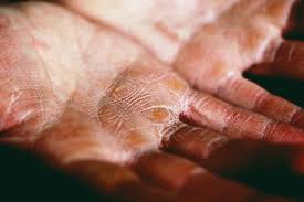 Image result for dyshidrosis