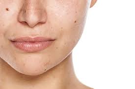 Almost all of us have some level of pigmentation; Skin Discoloaration Dark Spots Blemishes I Newport Cosmeceuticals