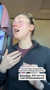 Effective Healing with Shelby Wright Balm for Scars