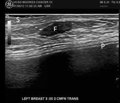 Learn more about the breast ultrasound the gel doesn't harm your skin or stain your clothes. Advances In Breast Ultrasound Springerlink