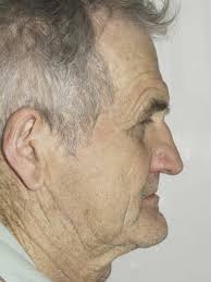 The Rectus Abdominis Myocutaneous Flap Combined With Vascularized Costal  Cartilages for Orbito-Malar Facial Reconstruction