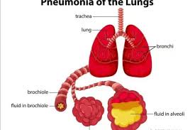 Lung cancer results in more fatalities in the united states than any other kind of cancer. Recognize Pneumonia Which Is Often Thought Of As A Cold World Today News