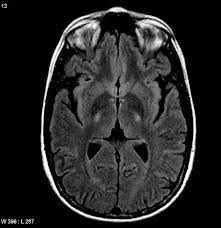Pin On Neurology