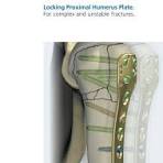 Locking Proximal Humerus Plate. For complex and ...