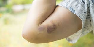 Check spelling or type a new query. Why Do I Bruise So Easily 8 Odd Causes Of Bruising Easily