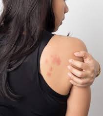 Image result for contact dermatitis