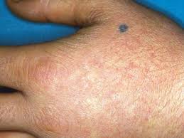 Image result for Photodermatitis