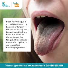 Image result for black hairy tongue symptoms