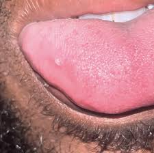 Image result for white cancer on tongue)
