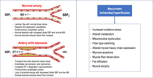 Peripheral Artery Disease Past Present And Future The American Journal Of Medicine