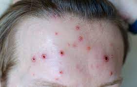 Meth Sores And Scabs Just Believe Recovery Pa