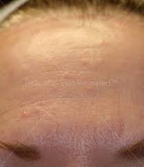 Image result for Sebaceous Hyperplasia
