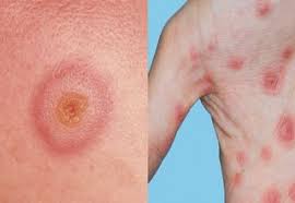 Image result for Erythema Multiforme Causes