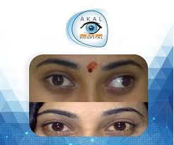 Strabismus Squint Surgery Akaleyehospital Com Strabismus Surgery Amblyopia Therapy Eye Care