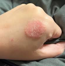 Image result for Eczema nummulare